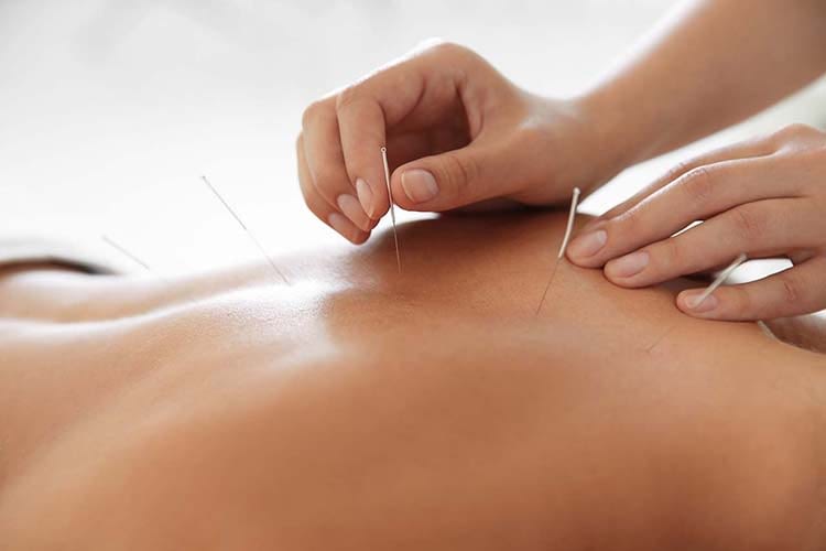 Dry Needling